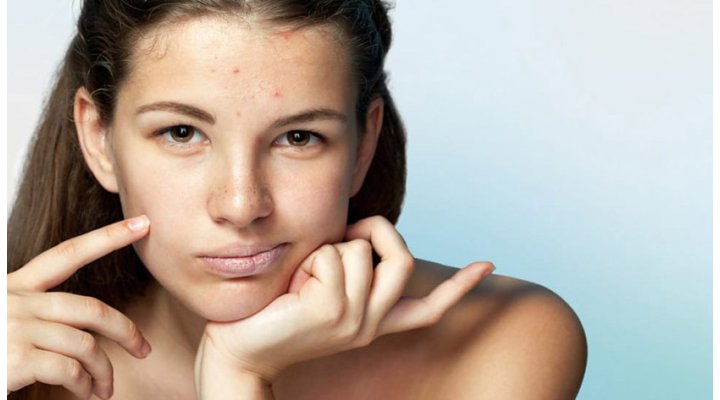 L'acne: cos'è e come curarla