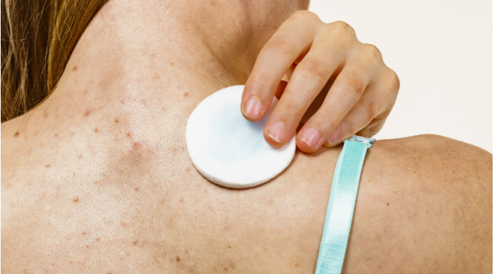 Acne sul corpo: come eliminare i brufoli su schiena, petto e spalle