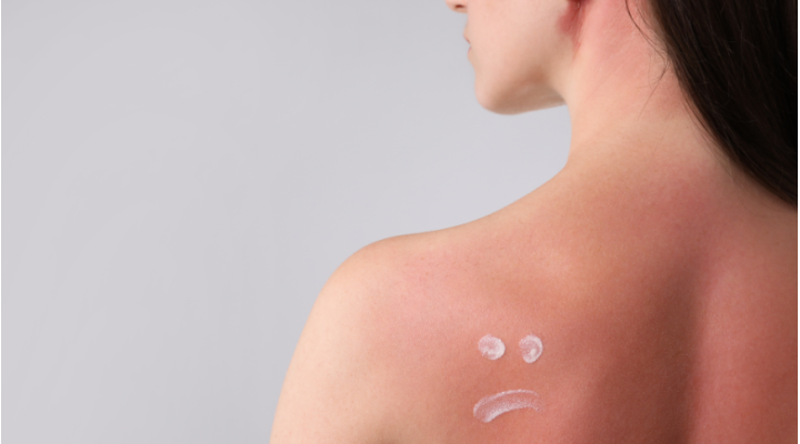 Crema per scottature solari: come scegliere quella giusta