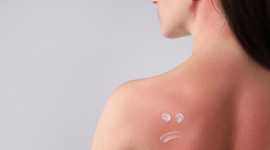 Crema per scottature solari: come scegliere quella giusta