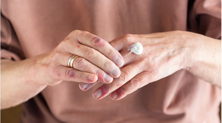 Dermatite e psicologia, quando pelle ed emozioni si parlano Dermatite e psicologia, quando pelle ed emozioni si parlano