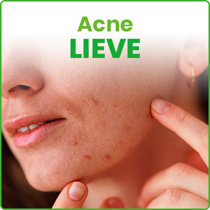 Acne Lieve