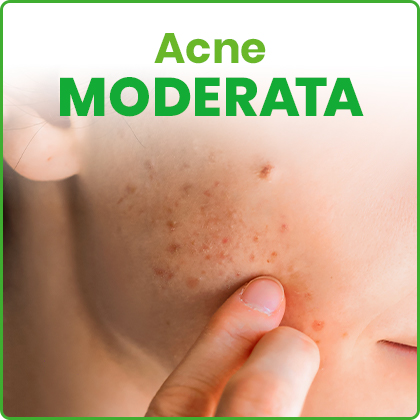 Acne Moderata