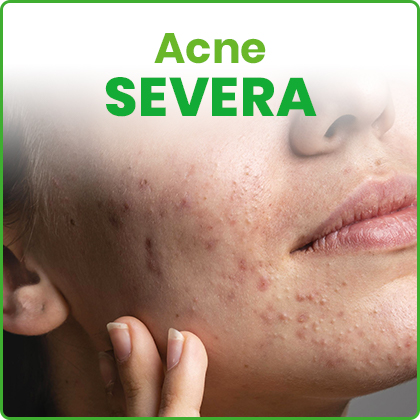 Acne Severa